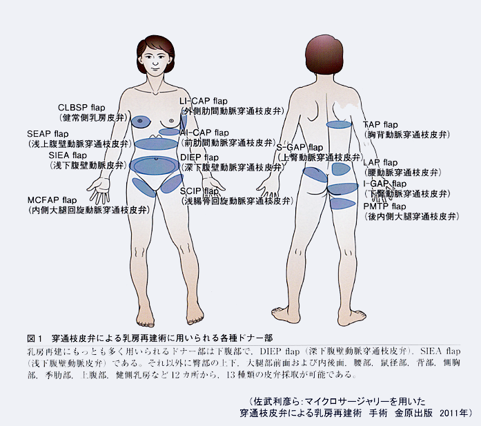 乳がん術後の乳房再建 – 富山大学附属病院 形成再建外科・美容外科